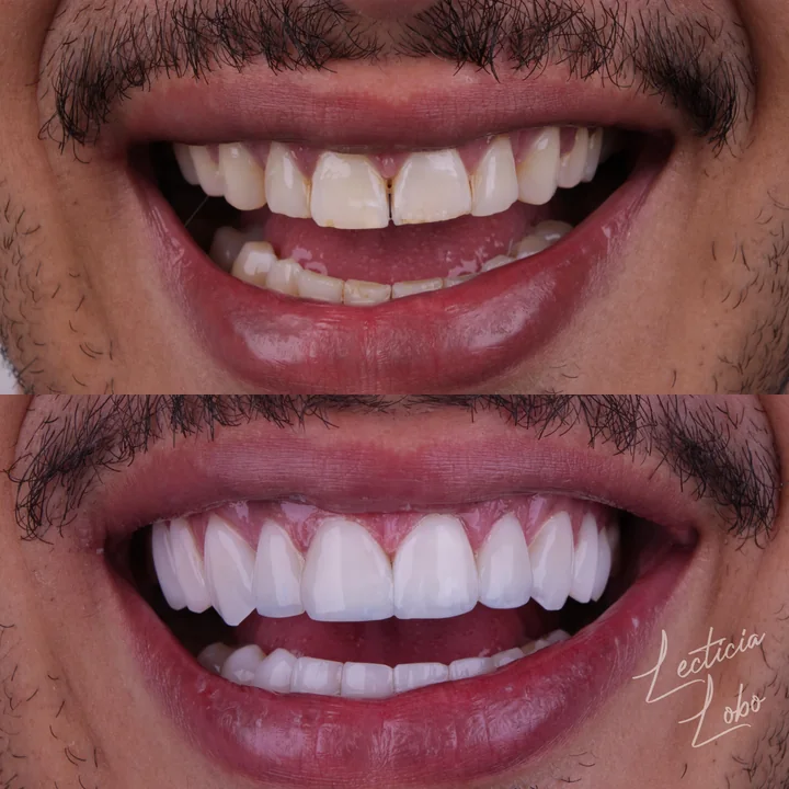 Antes e depois de facetas no sorriso