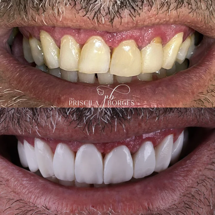 Antes e depois de facetas no sorriso