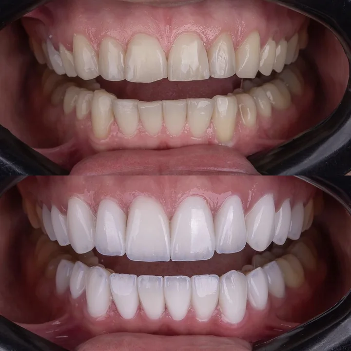 Antes e depois de facetas no sorriso