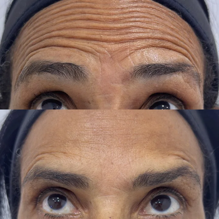 Antes e depois de toxina botulínica, linhas da testa