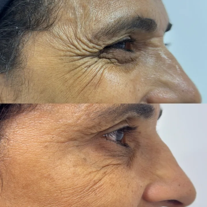Antes e depois de toxina botulínica, linhas ao redor dos olhos