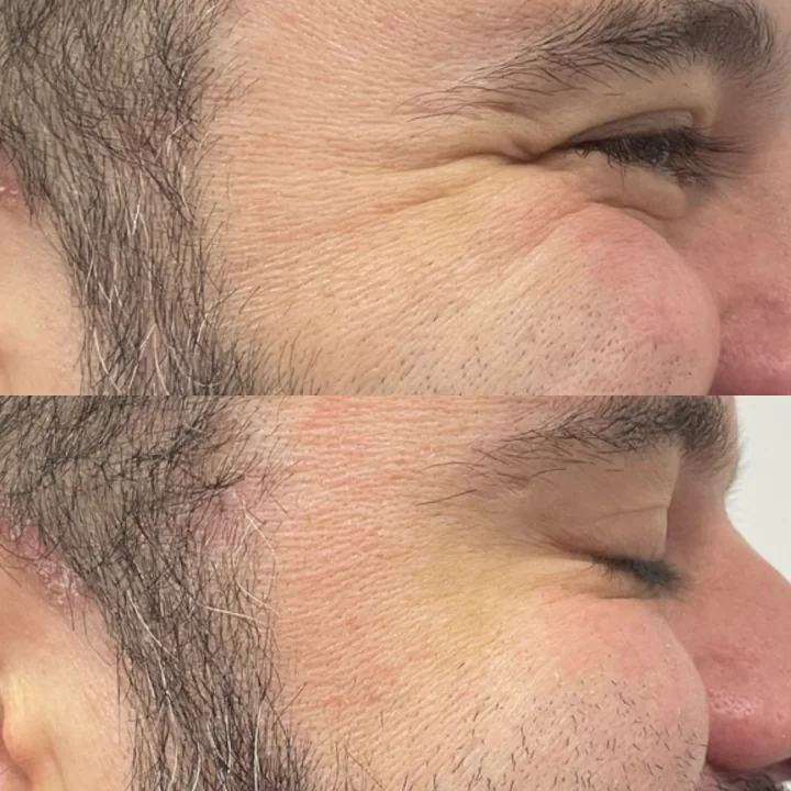 Antes e depois de toxina botulínica, linhas ao redor dos olhos