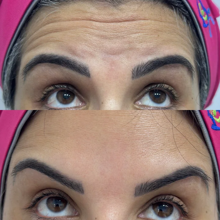 Antes e depois de toxina botulínica, linhas da testa