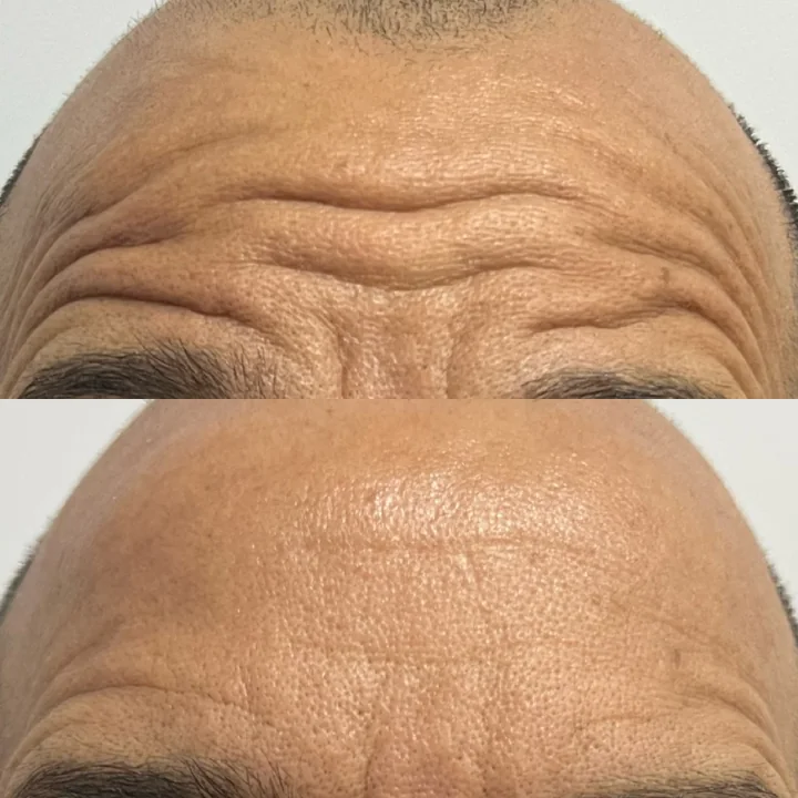 Antes e depois de toxina botulínica, linhas da testa