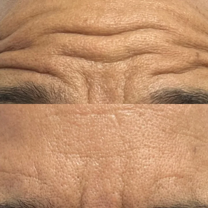 Antes e depois de toxina botulínica, linhas da testa