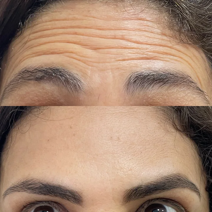 Antes e depois de toxina botulínica, linhas da testa