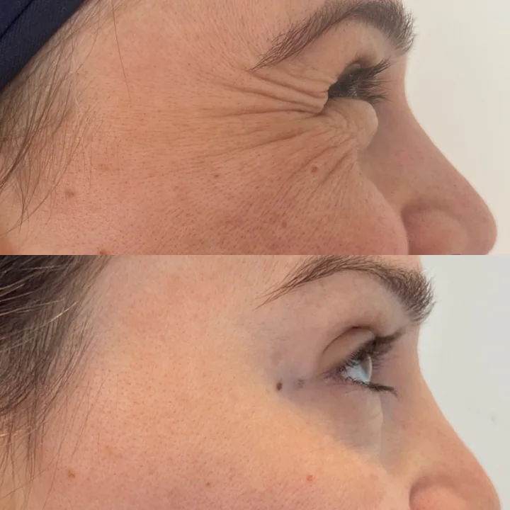 Antes e depois de toxina botulínica, linhas ao redor dos olhos