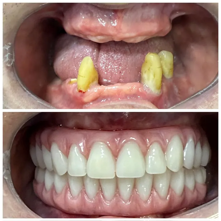 Antes e depois de protocolo com carga imediata, arcadas superior e inferior