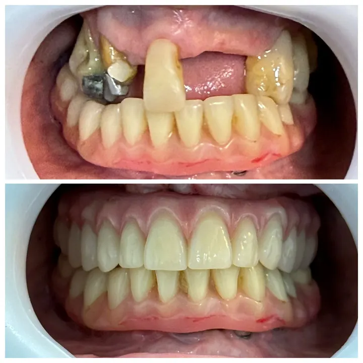 Antes e depois de protocolo com carga imediata, arcadas superior e inferior