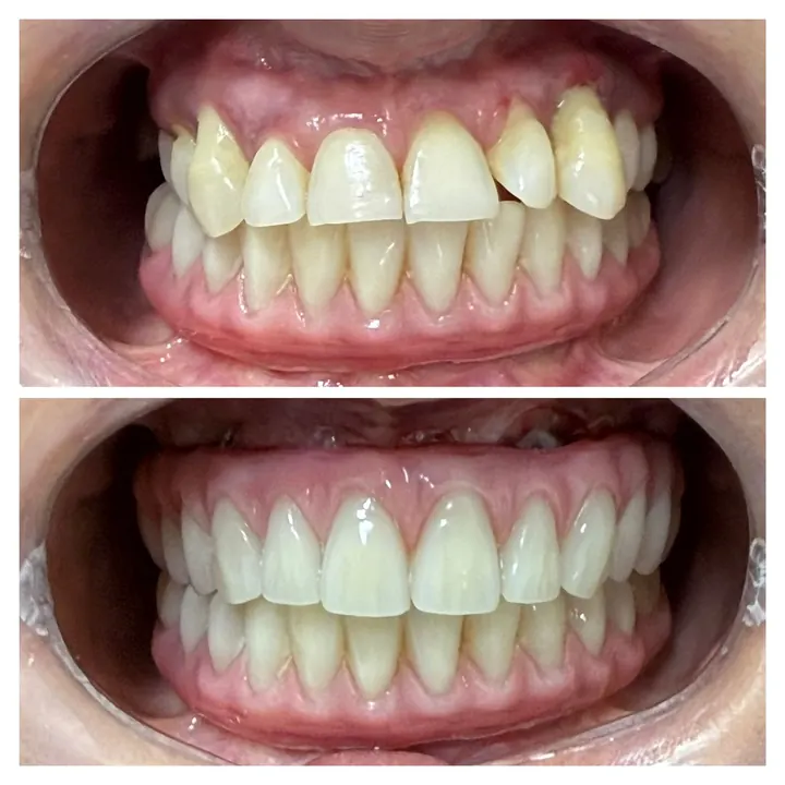 Antes e depois de protocolo com carga imediata, arcadas superior e inferior