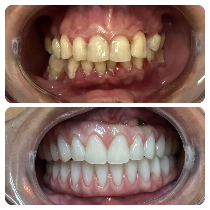 Antes e depois de protocolo com carga imediata, arcadas superior e inferior