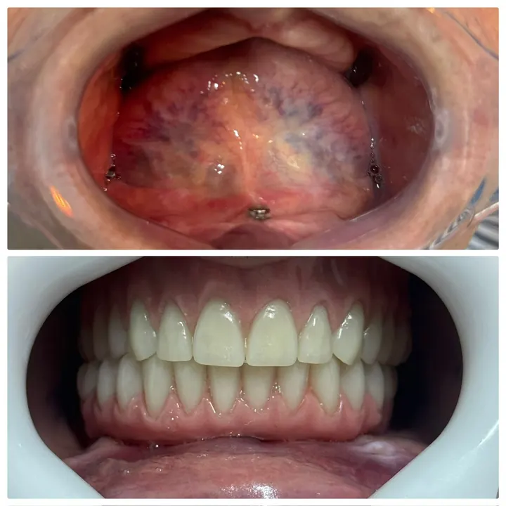 Antes e depois de protocolo com carga imediata, arcada superior