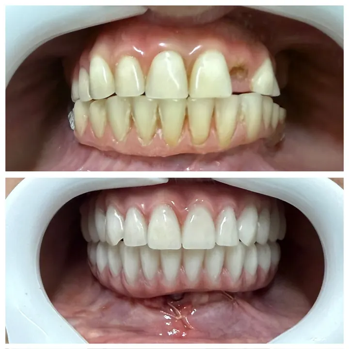 Antes e depois de protocolo com carga imediata, arcadas superior e inferior