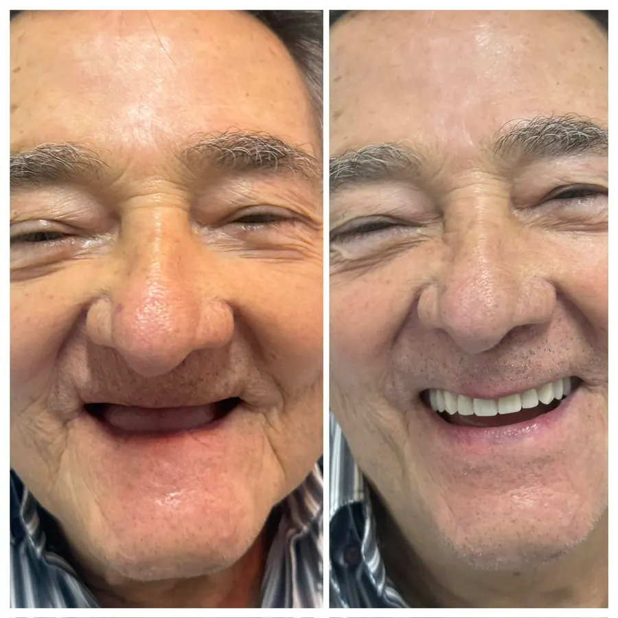 Antes e depois de protocolo com carga imediata, sorriso completo