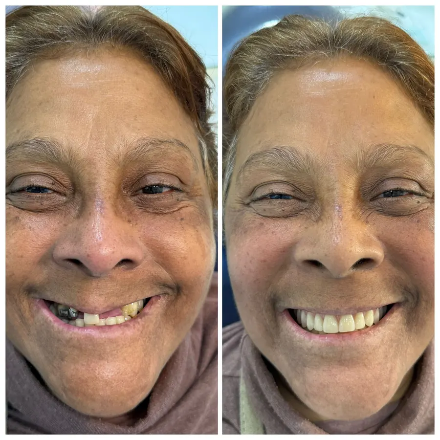 Antes e depois de protocolo com carga imediata, sorriso completo