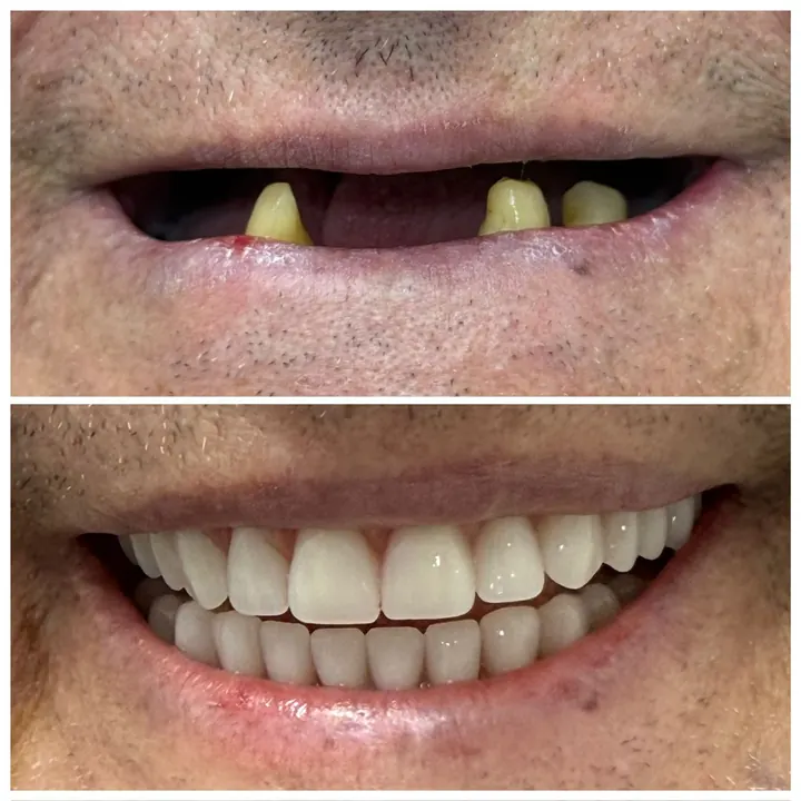 Antes e depois de protocolo com carga imediata, sorriso